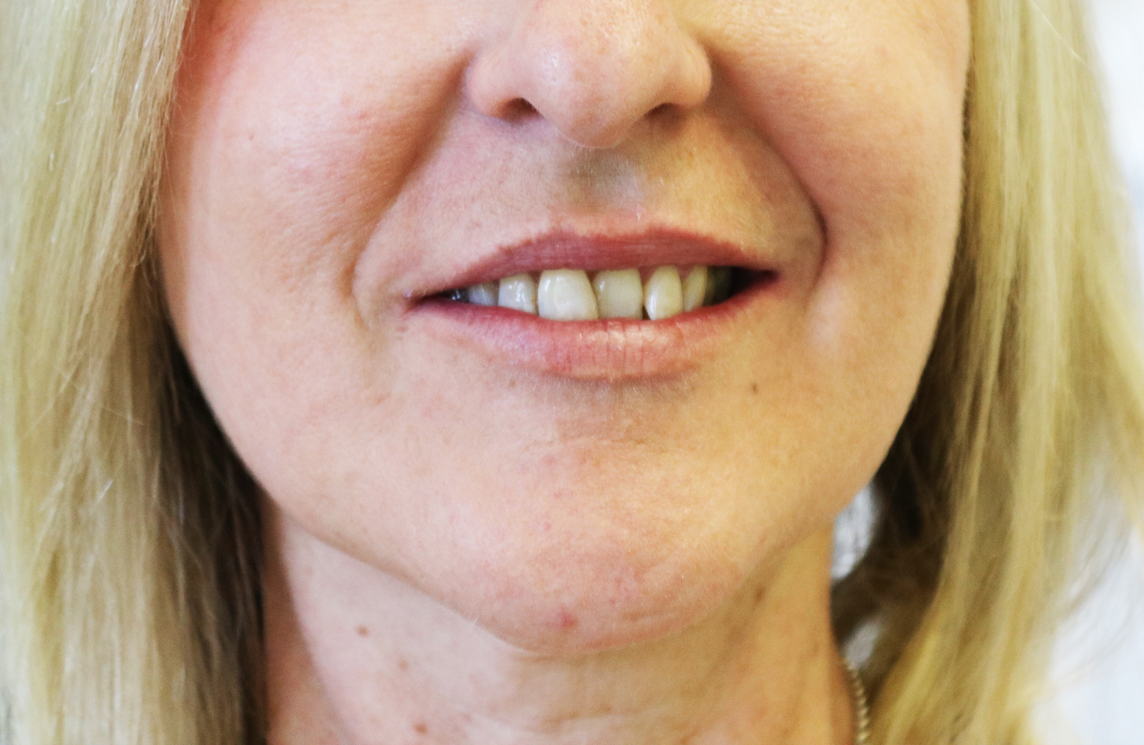 CLEAR ALIGNERS BEFORE