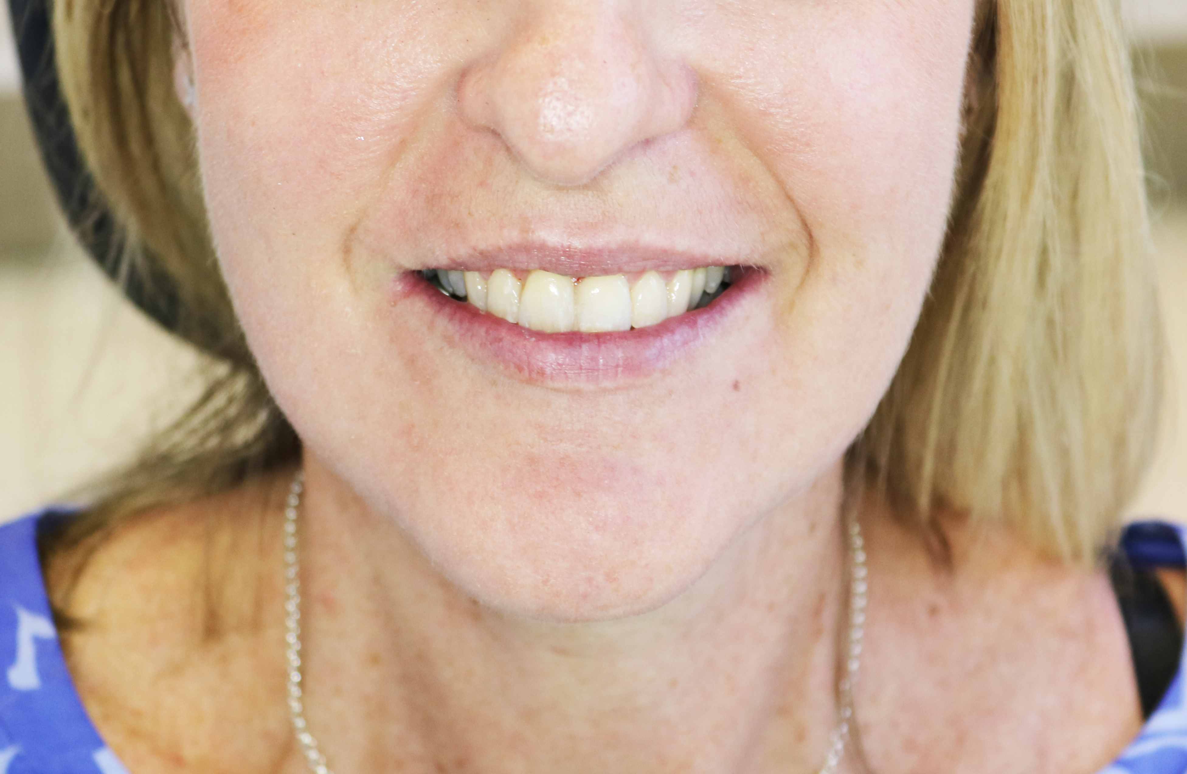 CLEAR ALIGNERS AFTER